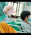 308激光白斑变大了怎么办小妙招